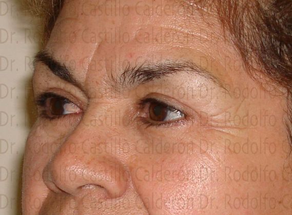 Blepharoplasty: Eyelid Surgery (over 50) - After eyelid surgery oblique view