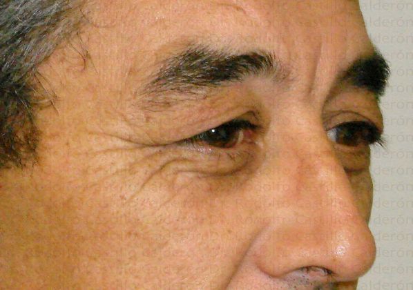 Blepharoplasty Male Eyelid Surgery - Before