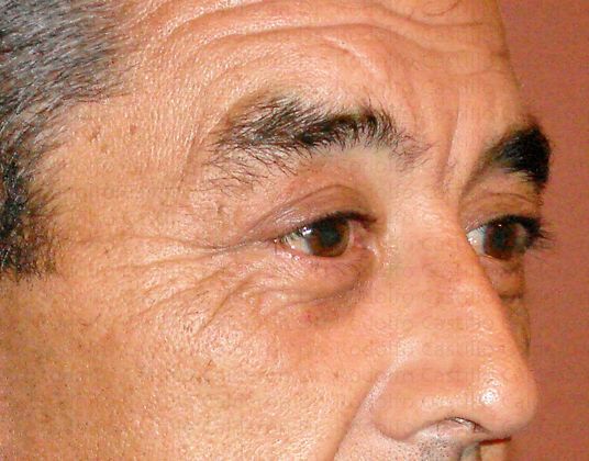 Blepharoplasty Male Eyelid Surgery - After