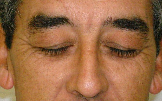 Blepharoplasty: Male Eyelid Surgery - Before eyelid surgery frontal view