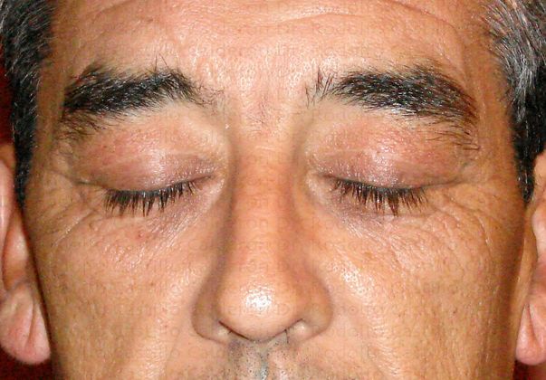 Blepharoplasty: Male Eyelid Surgery - After eyelid surgery frontal view
