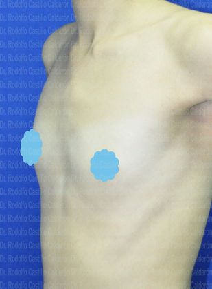 Breast Augmentation: Breast Augmentation (under the muscle) - Before Breast augmentation oblique view