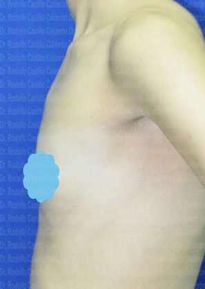 Breast Augmentation: Breast Augmentation (under the muscle) - Before Breast augmentation lateral view