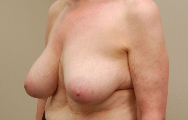 Breast Reduction: Case 11 - Before