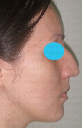 Rhinoplasty: Rhinoplasty with removal of the dorsal hump - Before Rhinoplasty Lateral View