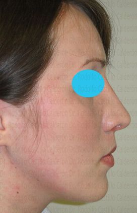 Rhinoplasty: Rhinoplasty with removal of the dorsal hump - After Rhinoplasty Lateral View
