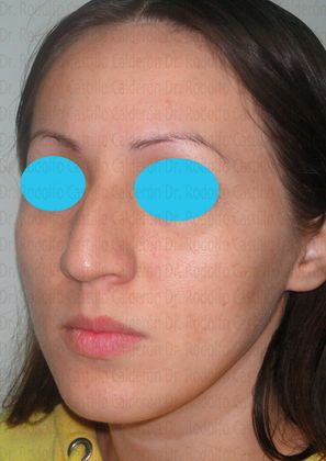 Rhinoplasty: Rhinoplasty with removal of the dorsal hump - Before Rhinoplasty oblique View
