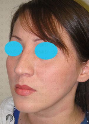 Rhinoplasty: Rhinoplasty with removal of the dorsal hump - After Rhinoplasty oblique View