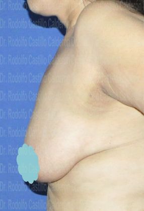 Breast Lift Breast Lift With breast Implants - Before