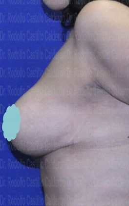 Breast Lift Breast Lift With breast Implants - After
