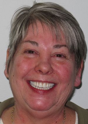 Prettau Zirconia Implant Bridge: Roxanne - After