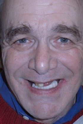 Prettau Zirconia Implant Bridge Kenneth - Before