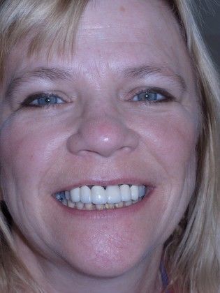 Prettau Zirconia Implant Bridge: Linda - Before Prettau