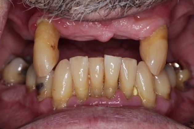 Prettau Zirconia Implant Bridge: Robert - Before Prettau Zirconia