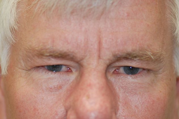 Endoscopic Brow Lift Case 3 - Before