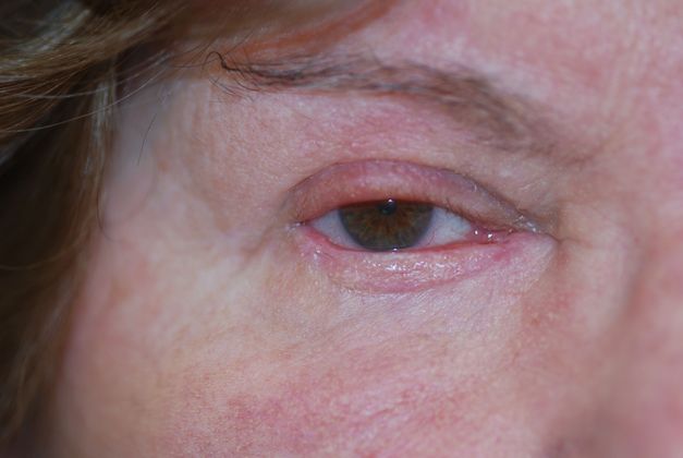 Facial Tumors and Growths Case 10 - After