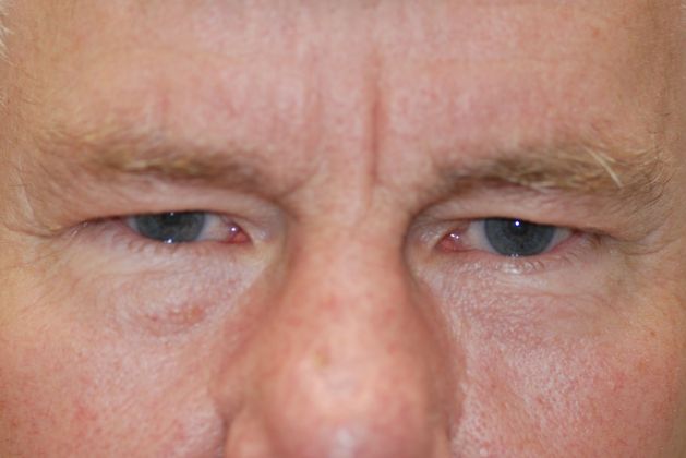 Upper Eyelid Blepharoplasty Case 10 - Before