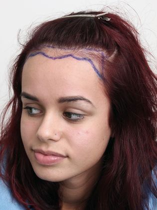 Hair Transplant - Female: Hairline FUT - Before FUT hair transplant