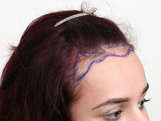 Hair Transplant - Female Hairline FUT - Before