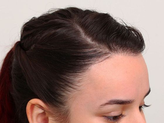 Hair Transplant - Female Hairline FUT - After