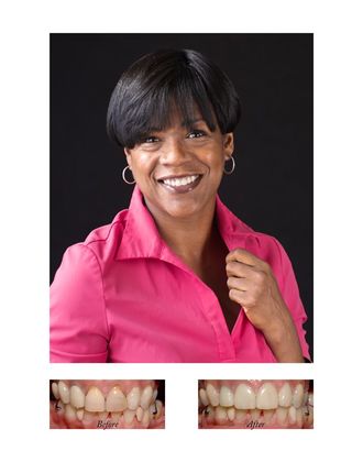 Porcelain Crowns Cases