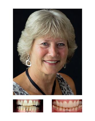 Porcelain Veneers Cases