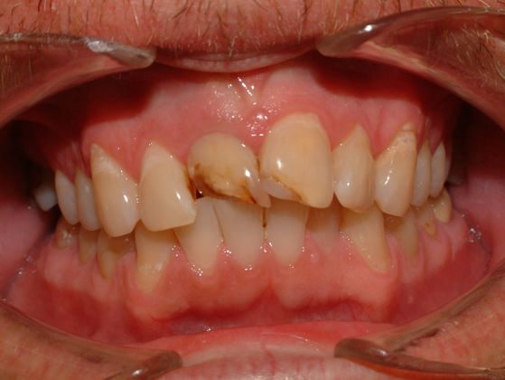 Porcelain Crowns: Case 4 - Before