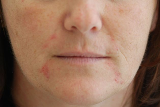Dermal Fillers: Case 1 - After
