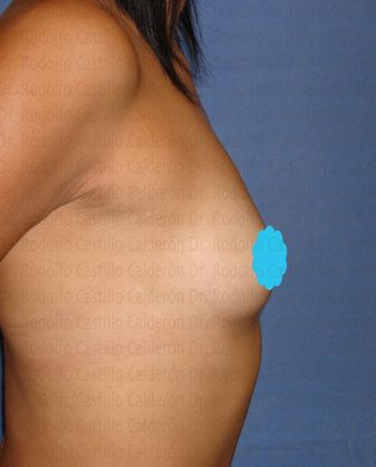 Breast Augmentation: Breast Augmentation with round implants (over the muscle) - Before Breast augmentation lateral view
