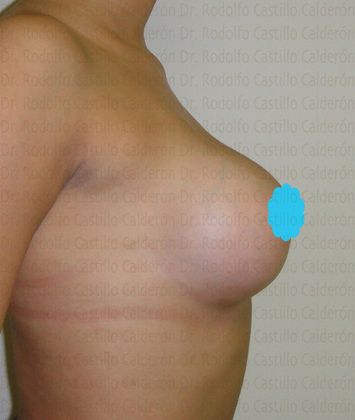 Breast Augmentation: Breast Augmentation with round implants (over the muscle) - After Breast augmentation lateral view