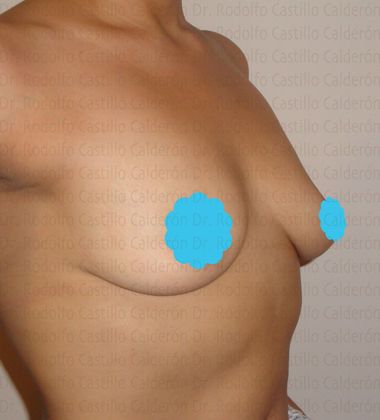 Breast Augmentation Breast augmentation after breast feeding (over the muscle) - Before