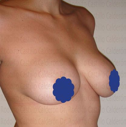 Breast Lift: Breast Lift With breast Implants change - Before breast lift with implants change oblique view