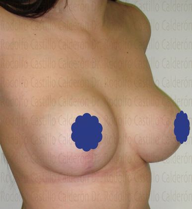 Breast Lift: Breast Lift With breast Implants change - After Breast lift with implants change oblique view