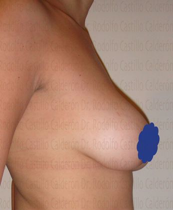 Breast Lift: Breast Lift With breast Implants change - Before breast lift with implants change lateral view