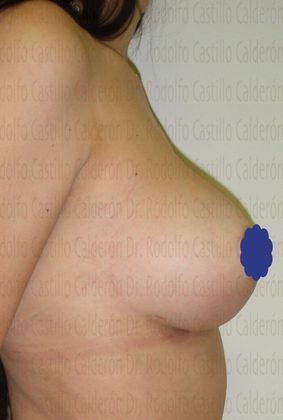 Breast Lift: Breast Lift With breast Implants change - After breast lift with implants change lateral view