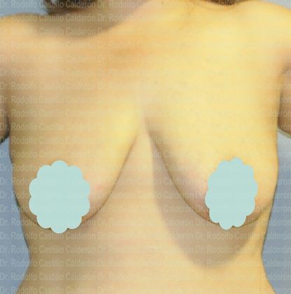 Breast Lift Breast Lift With breast Implants (over the muscle) - Before
