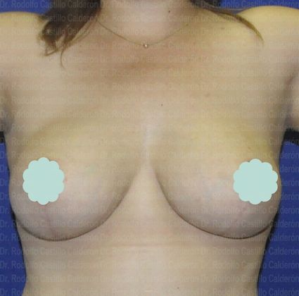 Breast Lift Breast Lift With breast Implants (over the muscle) - After