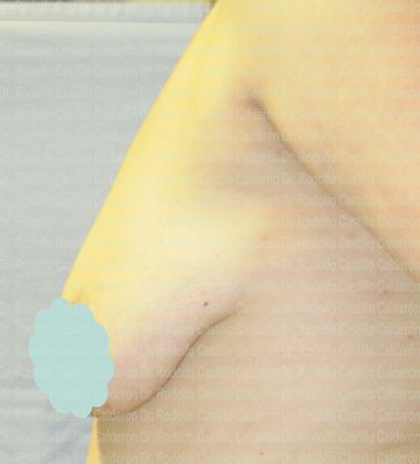 Breast Lift: Breast Lift With breast Implants (over the muscle) - Before breast lift with implants lateral view