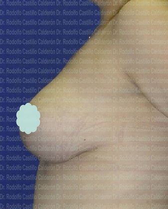 Breast Lift: Breast Lift With breast Implants (over the muscle) - After breast lift with implants lateral view