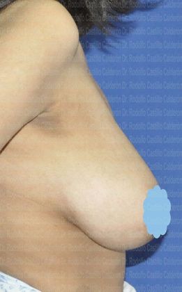 Breast Reduction: Teenager Breast Reduction (18) - Before Breast Reduction lateral view