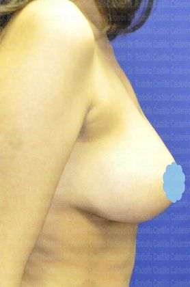 Breast Reduction: Teenager Breast Reduction (18) - After Breast Reduction Lateral View