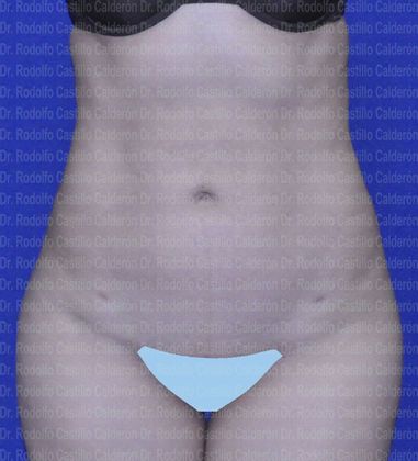 Liposuction: Paient with one kid and good skin quality - After liposcultpture frontal view
