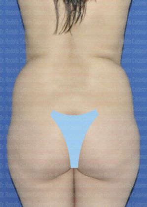 Liposuction: Paient with one kid and good skin quality - Before Liposcultpture posterior view