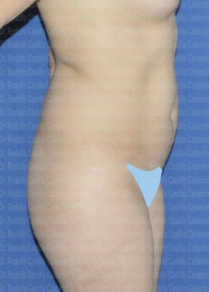 Liposuction: Paient with one kid and good skin quality - Before Liposcultpture lateral view
