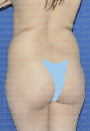 Liposuction: Paient with one kid and good skin quality - Before Liposcultpture posterior oblique view
