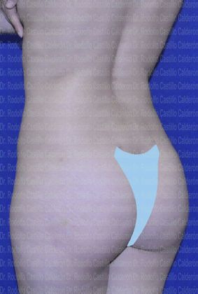 Liposuction: Paient with one kid and good skin quality - After Liposcultpture posterior oblique view