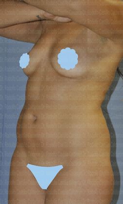Mommy Makeover -Abdomen, Breast, Lipo, BBL- Patient with liposculpture and Breast Augmentation - Before