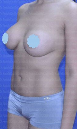 Mommy Makeover -Abdomen, Breast, Lipo, BBL- Patient with liposculpture and Breast Augmentation - After