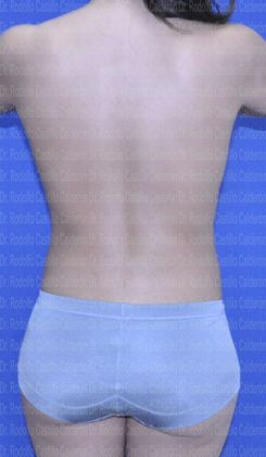 Mommy Makeover -Abdomen, Breast, Lipo, BBL-: Patient with liposculpture and Breast Augmentation - After Mommy Makeover posterior View