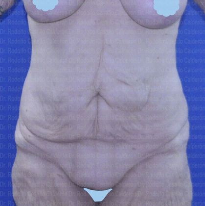 Post Bariatric Plastic Surgery Belt Lipectomy after losing 160 lbs - Before